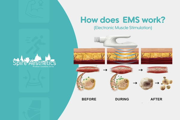EMS treatment for post pregnancy weight loss treatment Leicester