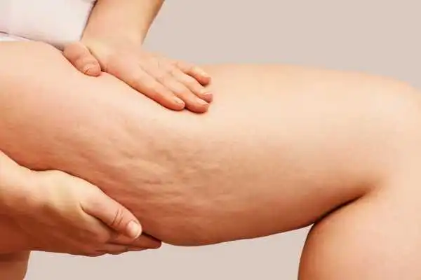 Image of woman showing leg with cellulite Leicester