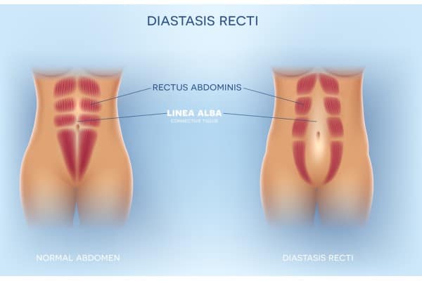 What Non-Surgical Options Are Available for Diastasis Recti Leicester?