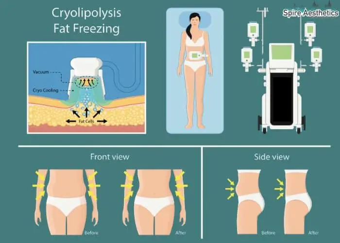 Fat freezing treatment Leicester benefits for competitions to remove stubborn fat deposits.