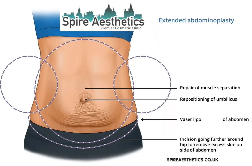 Understanding Loose Skin After Gastric Band Leicester Surgery and HIFU Treatment