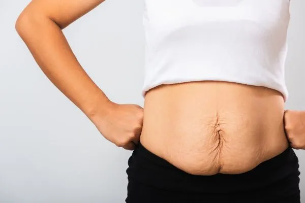 Image of a woman's stomach after weight loss with sagging skin following a gastric band Leicester