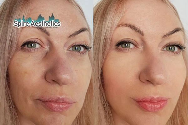 Morpheus8 Treatment Leicester Before & After Results