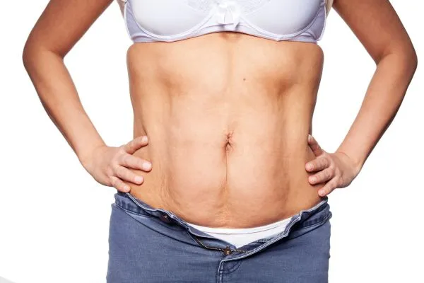 sagging skin on woman's stomach after weight loss injections Leicester