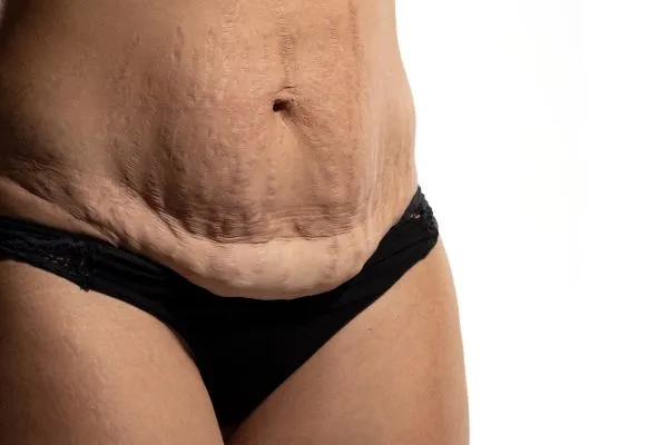 Image of womans stomach after weight loss injections Leicester showing saggy skin