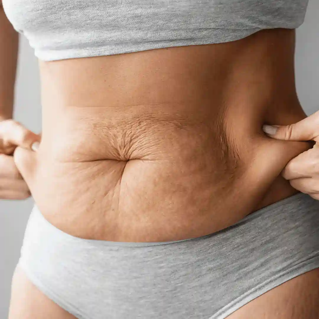 Is It Normal to Have Loose Skin After Pregnancy Leicester?