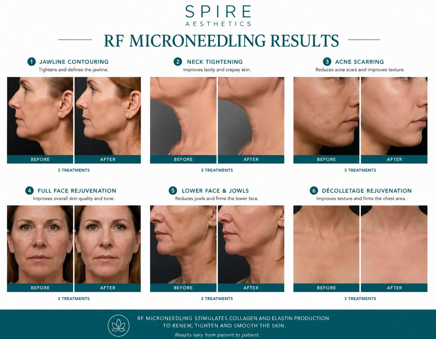 RF Microneedling Skin tightening Leicester results