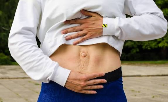 When Could Diastasis Recti Be the Missing Piece of the Puzzle Leicester?