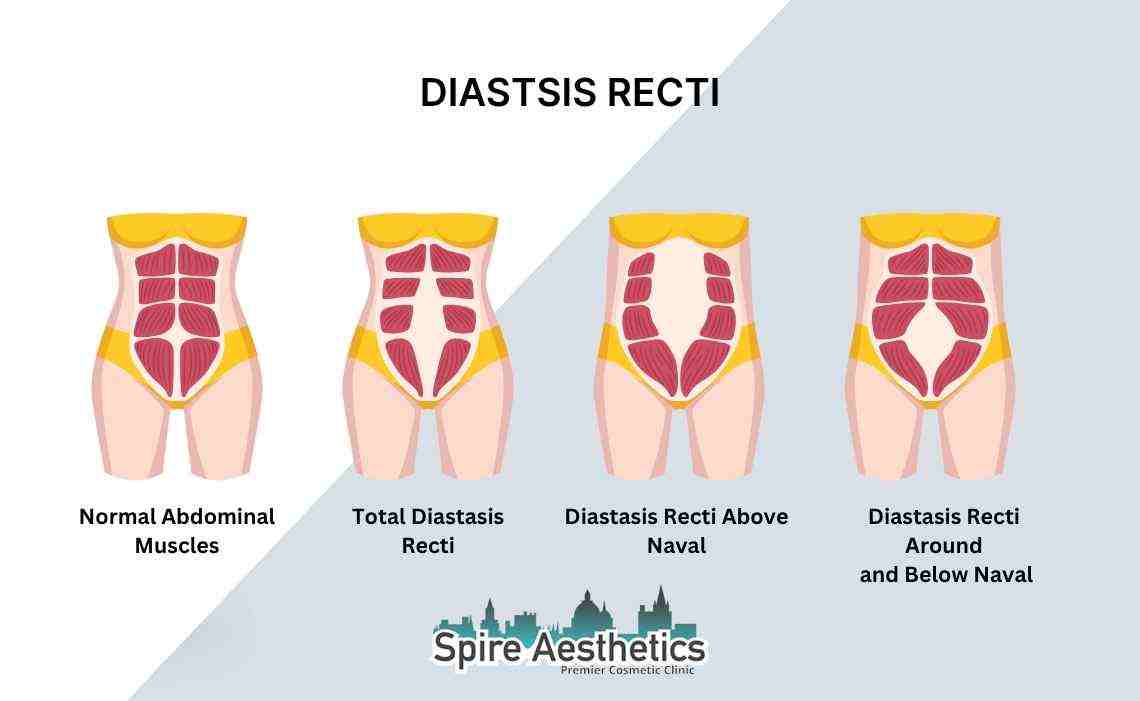 Is Non-Surgical Diastasis Recti Treatment Right for You? Common Concerns Answered Leicester